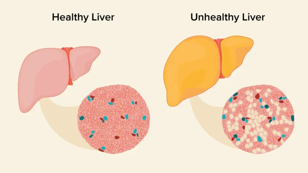 How to remove fat from the liver