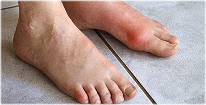 You might start noticing a gout symptom .