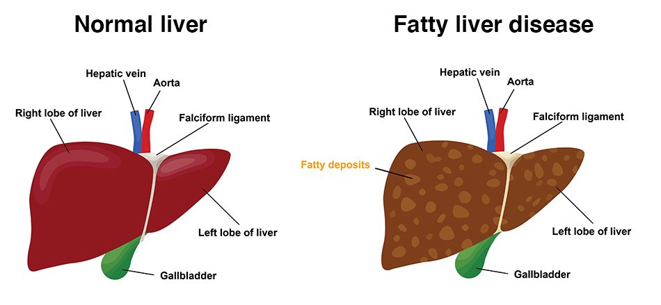 A big symptom of a fatty liver