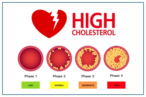 High cholesterol 