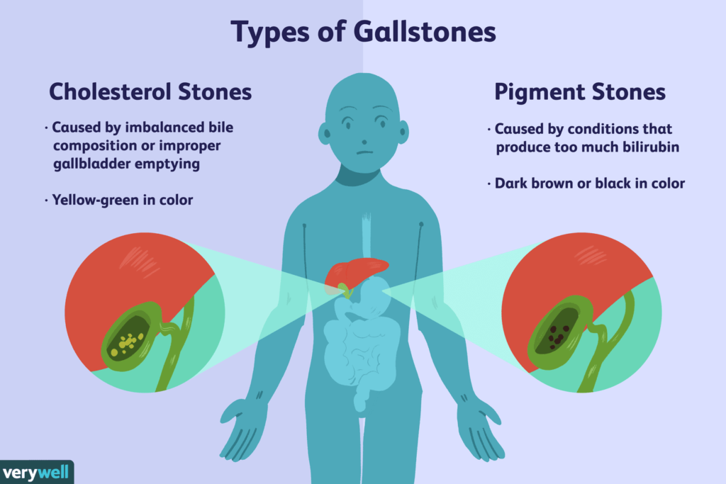 Gallstones 