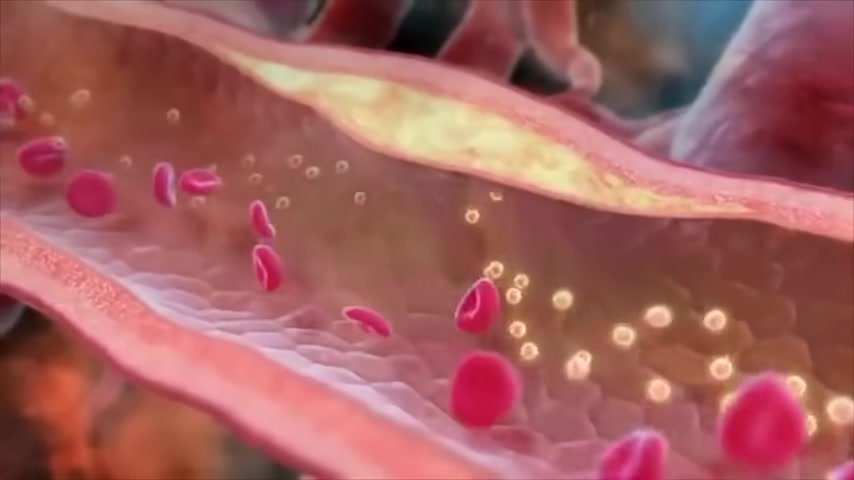 Vitamin K2 pathological calcification