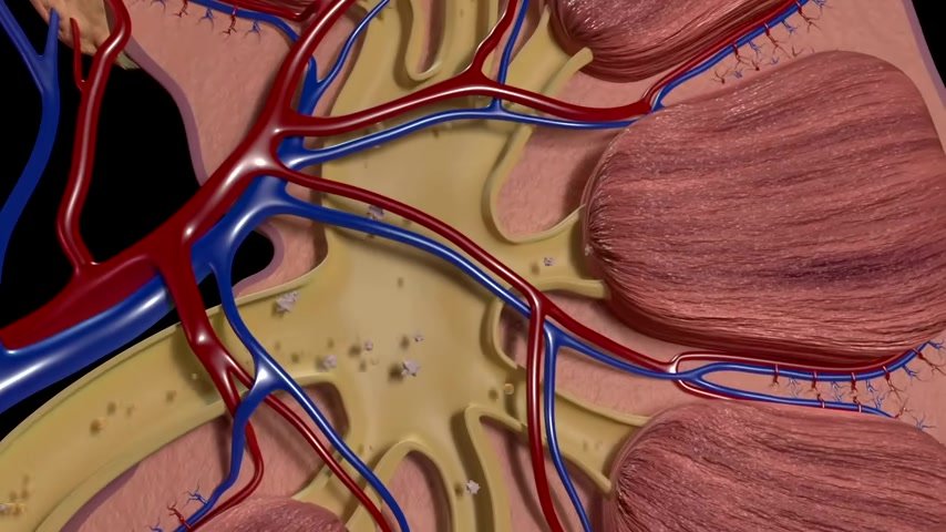 Vitamin D toxicity- kidney stones .