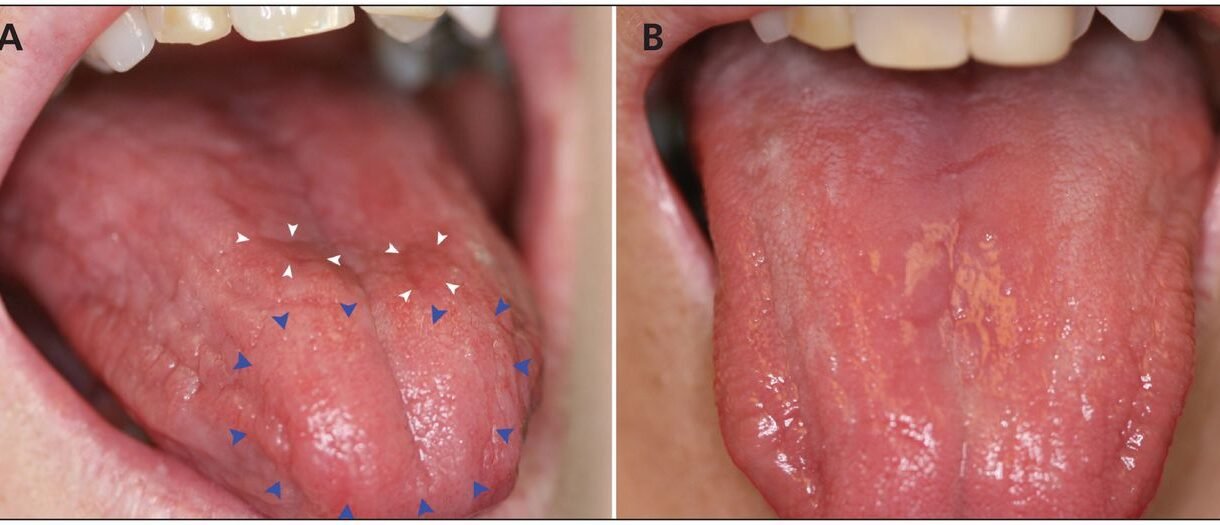 The Tongue Can Determine a Vitamin C Deficiency