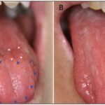 The Tongue Can Determine a Vitamin C Deficiency