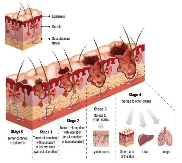 skin cancer paradox 