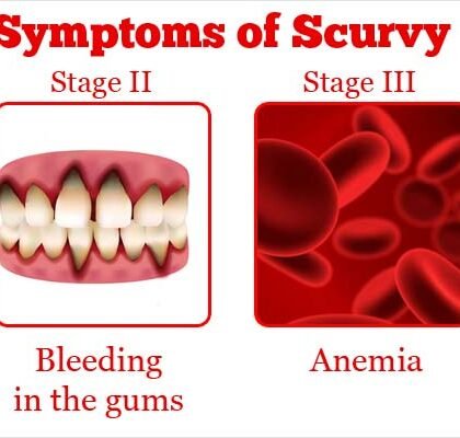 Vitamin C Deficiency (Subclinical Scurvy)