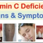 4 Subclinical Vitamin C Deficiency Signs that are Extremely Common