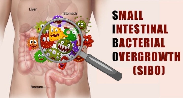 SIBO: How It Steals Your Nutrients and 5 Effective Solutions