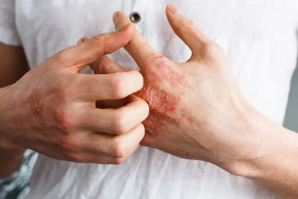 Eczema 