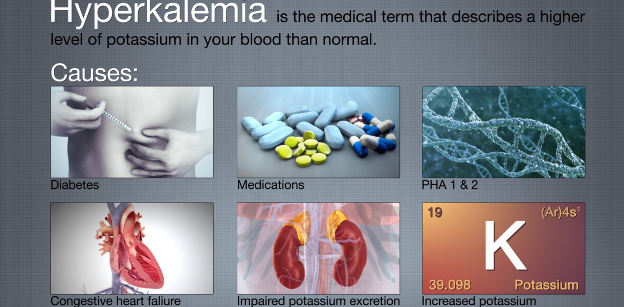 Hyperkalemia (High Potassium Levels)-Symptoms & Treatment