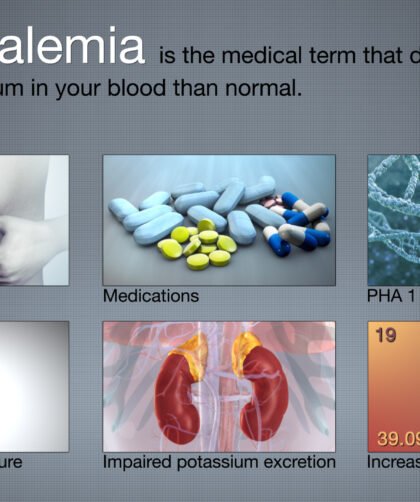 Hyperkalemia (High Potassium Levels)-Symptoms & Treatment
