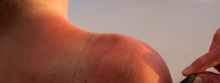  skin damage from the sun