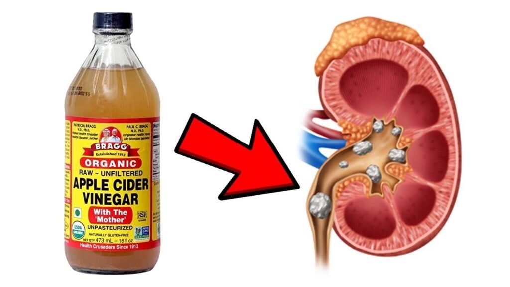 Use Apple Cider Vinegar to Dissolve Kidney Stones