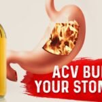 Does Apple Cider Vinegar Burn Your Stomach?