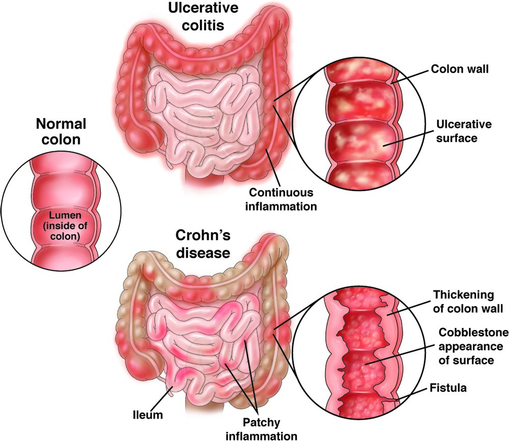 Decreasing Intestinal Inflammation