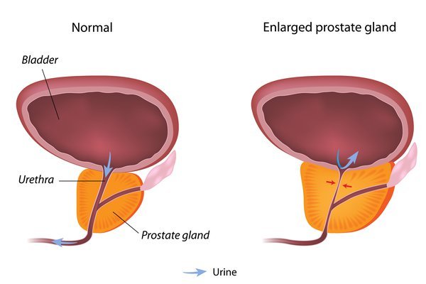 prostate