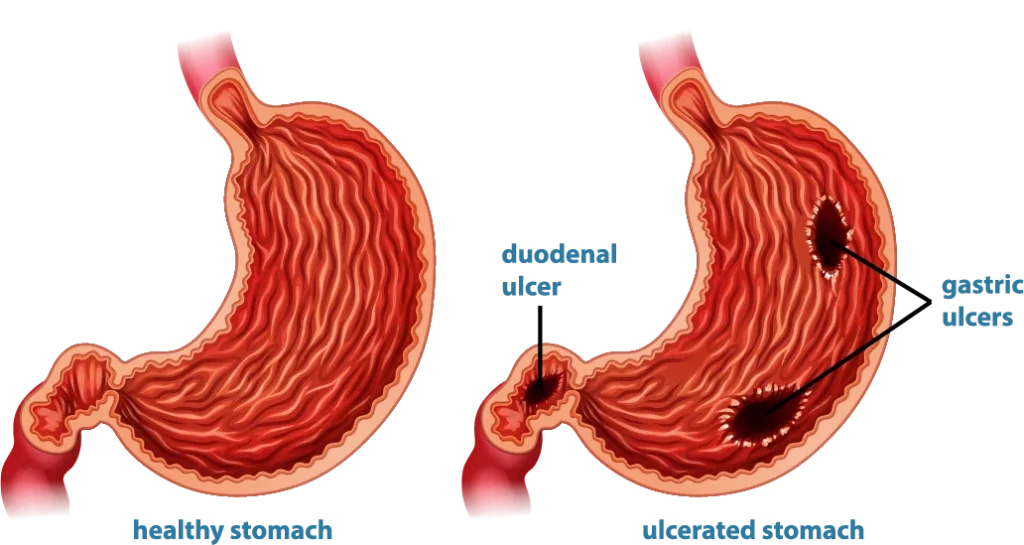 stomach ulcers and gastritis