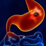 Suffering From Gastric Ulcers? You May Be Deficient in Zinc