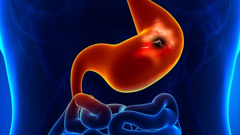 Suffering From Gastric Ulcers? You May Be Deficient in Zinc