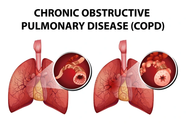 Zinc and Lungs: Increased Cytokines