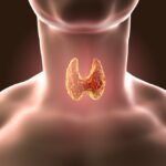 Subclinical Hypothyroidism and Zinc Deficiency