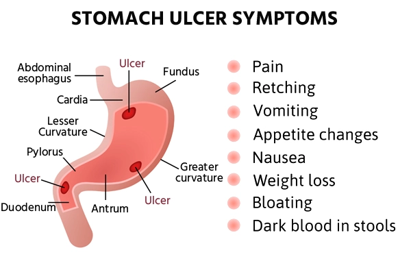 Gastric Ulcers