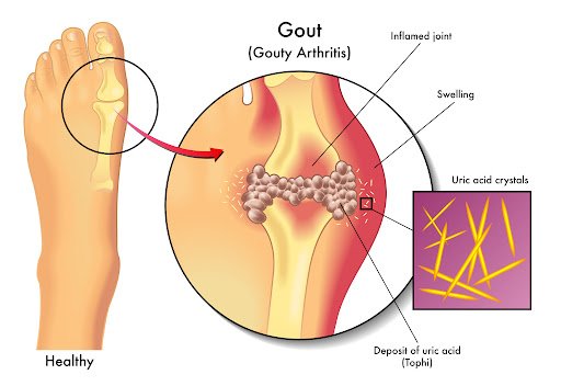 Alkalizing Effect and Gout Prevention